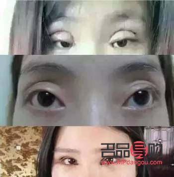 雙眼皮美學：探索不同的雙眼皮形態