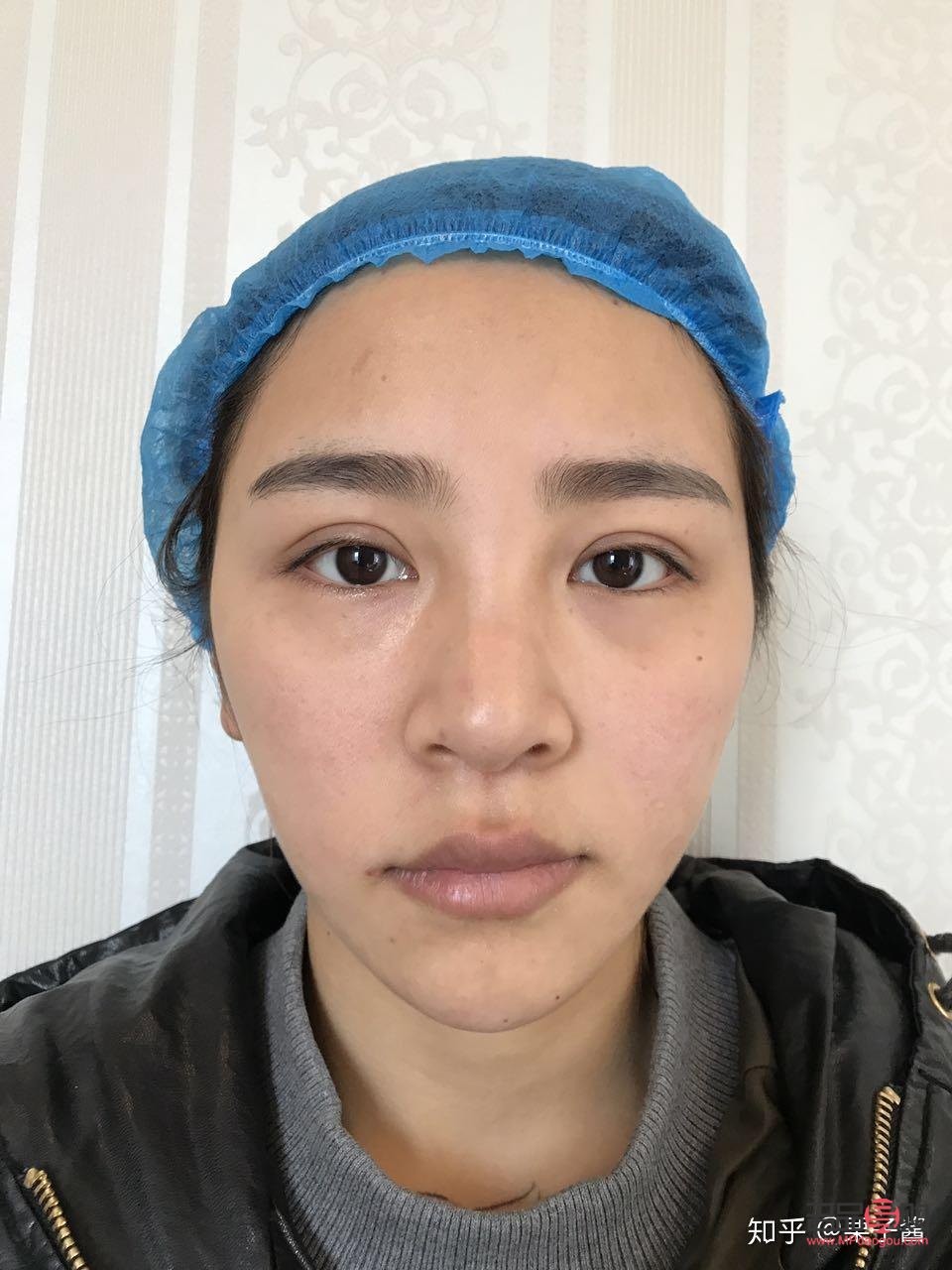 <h3>雙眼皮做寬了能否修復？</h3>