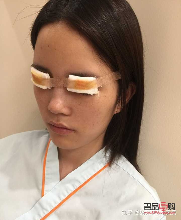 雙眼皮做寬了能否修復？