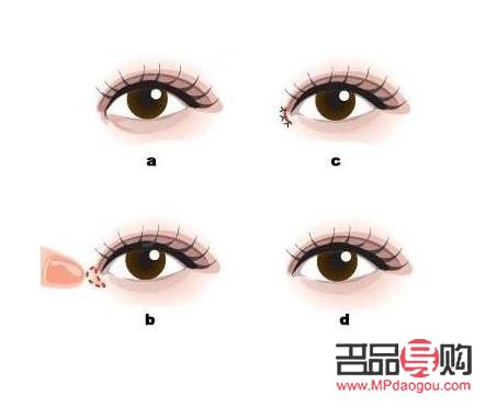 開完眼角是否能恢復到以前？