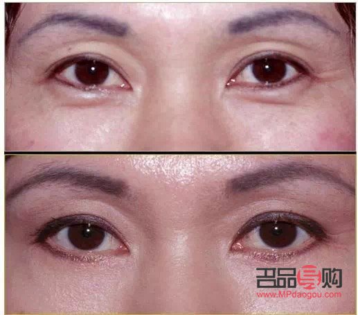 眼袋里面脂肪怎么疏通(眼袋里面脂肪怎么疏通經絡)