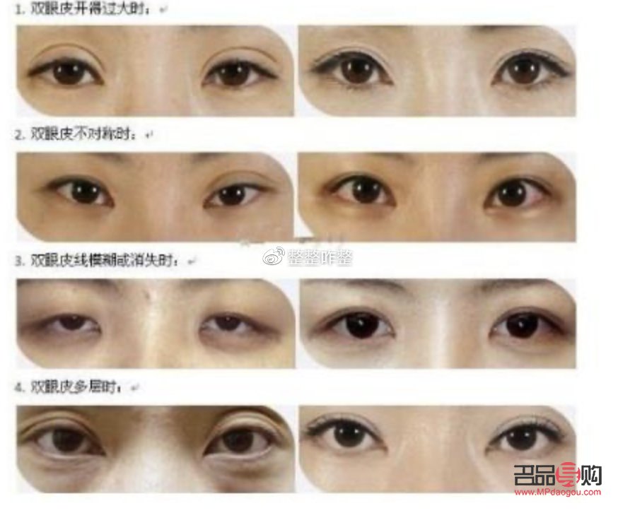 <h3>雙眼皮一邊寬一邊窄面相解析</h3>