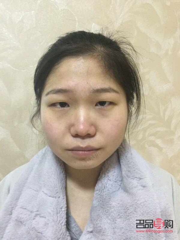 <h3>解決單眼皮下垂的有效方法</h3>