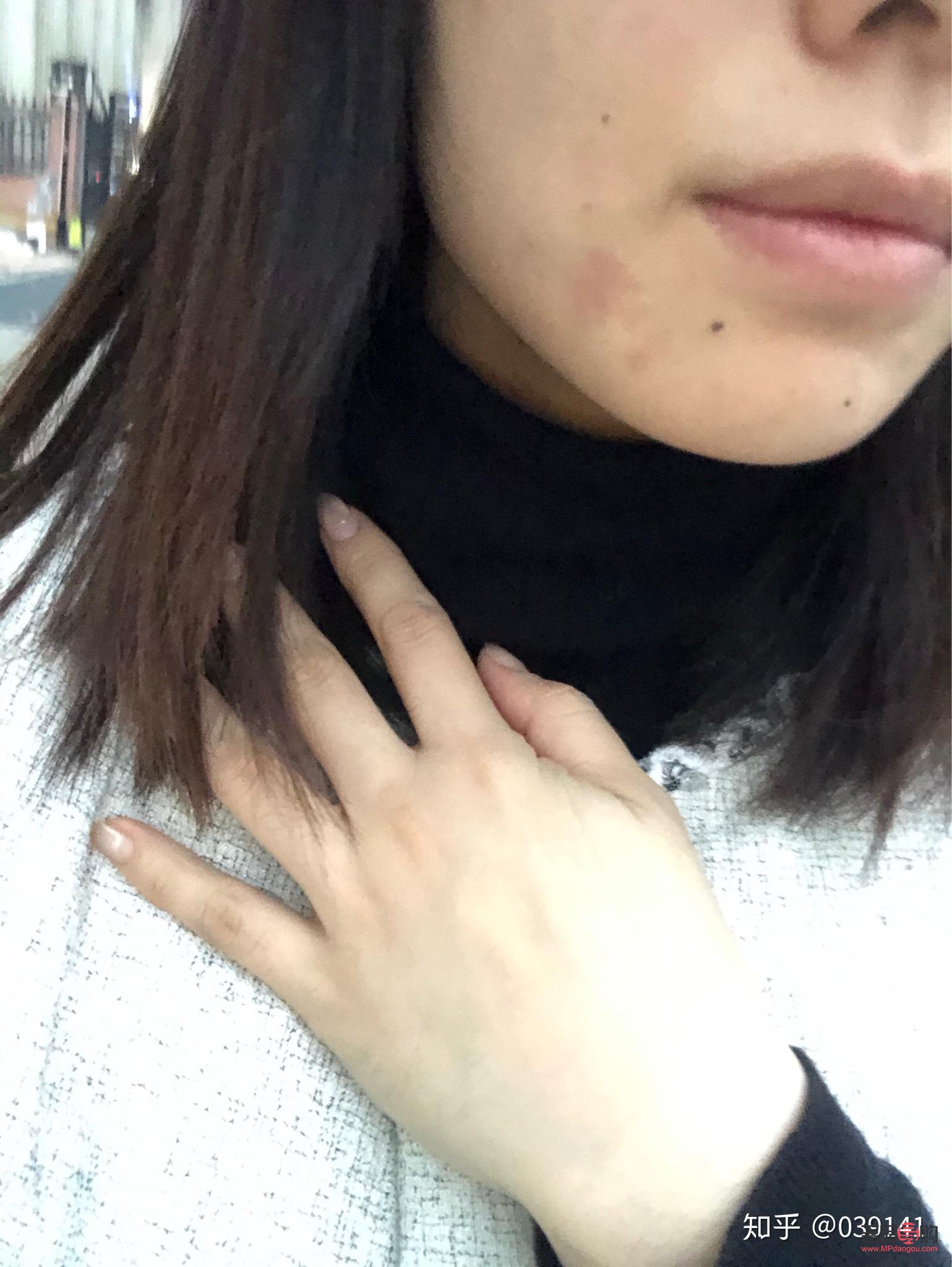 眼角回包手術過程多久(眼角回包手術過程多久恢復)