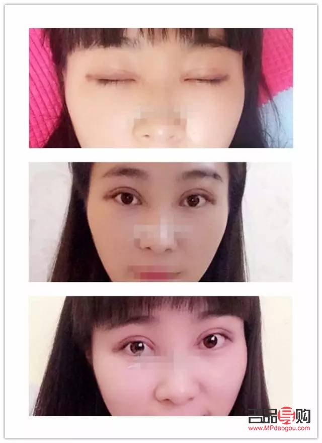 7.5毫米雙眼皮恢復圖片(7.5毫米雙眼皮恢復圖片大全)
