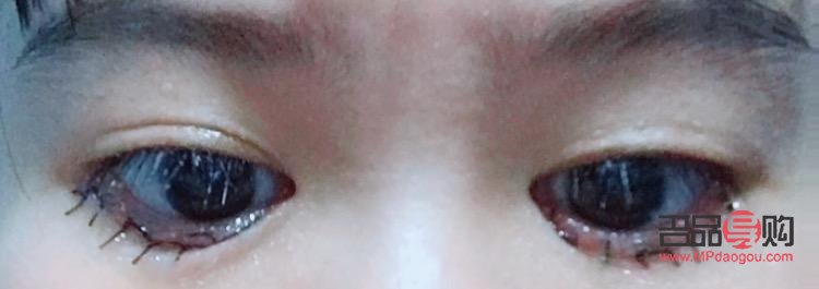 眼睛倒睫手術后會留疤嗎(眼睛倒睫手術后會留疤嗎圖片)