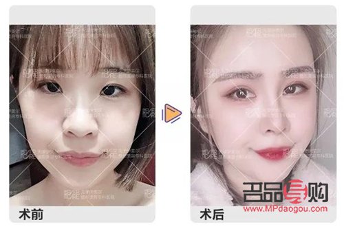 翹睫雙眼皮是永久的嗎怎么做(翹睫雙眼皮是永久的嗎怎么做手術)