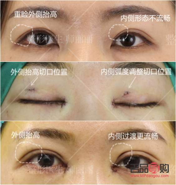 做什么雙眼皮恢復快(做什么雙眼皮恢復快能保持永久)