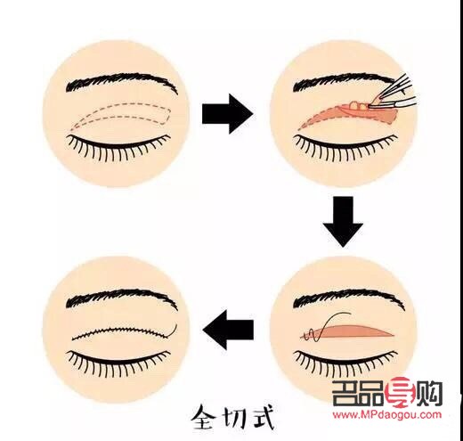 <h3>內雙如何埋線打造雙眼皮魅力</h3>