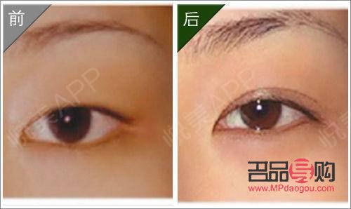 內雙如何埋線打造雙眼皮魅力
