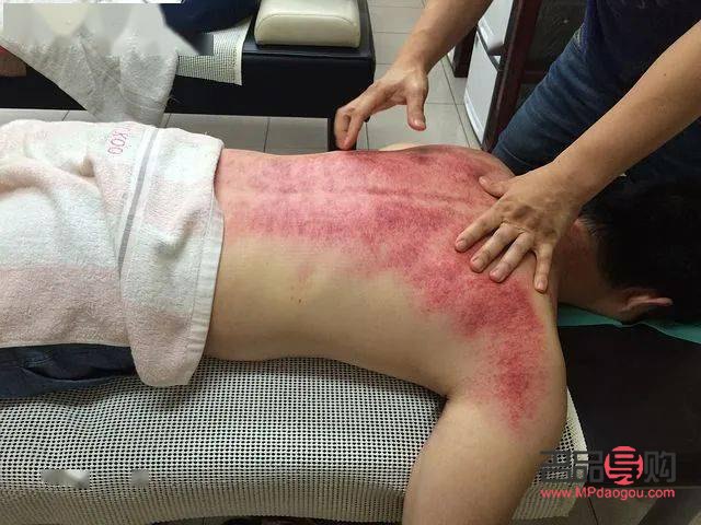 刮痧后的身體護(hù)理之道