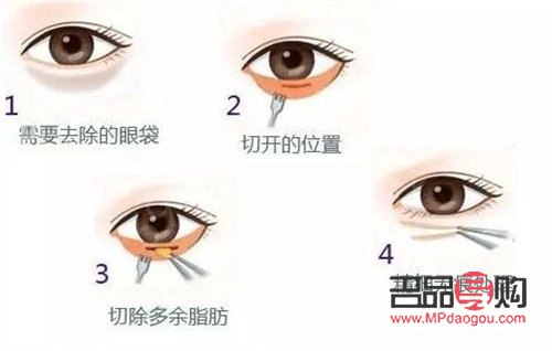 去淚溝眼袋手術費用知多少
