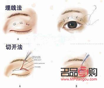 割雙眼皮手術前需要注意什么(割雙眼皮手術前需要注意什么事項)