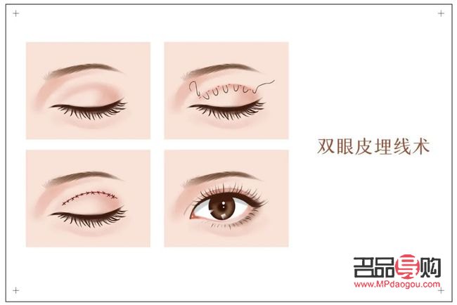 雙眼皮哪一種手術更好看(雙眼皮哪一種手術更好看些)