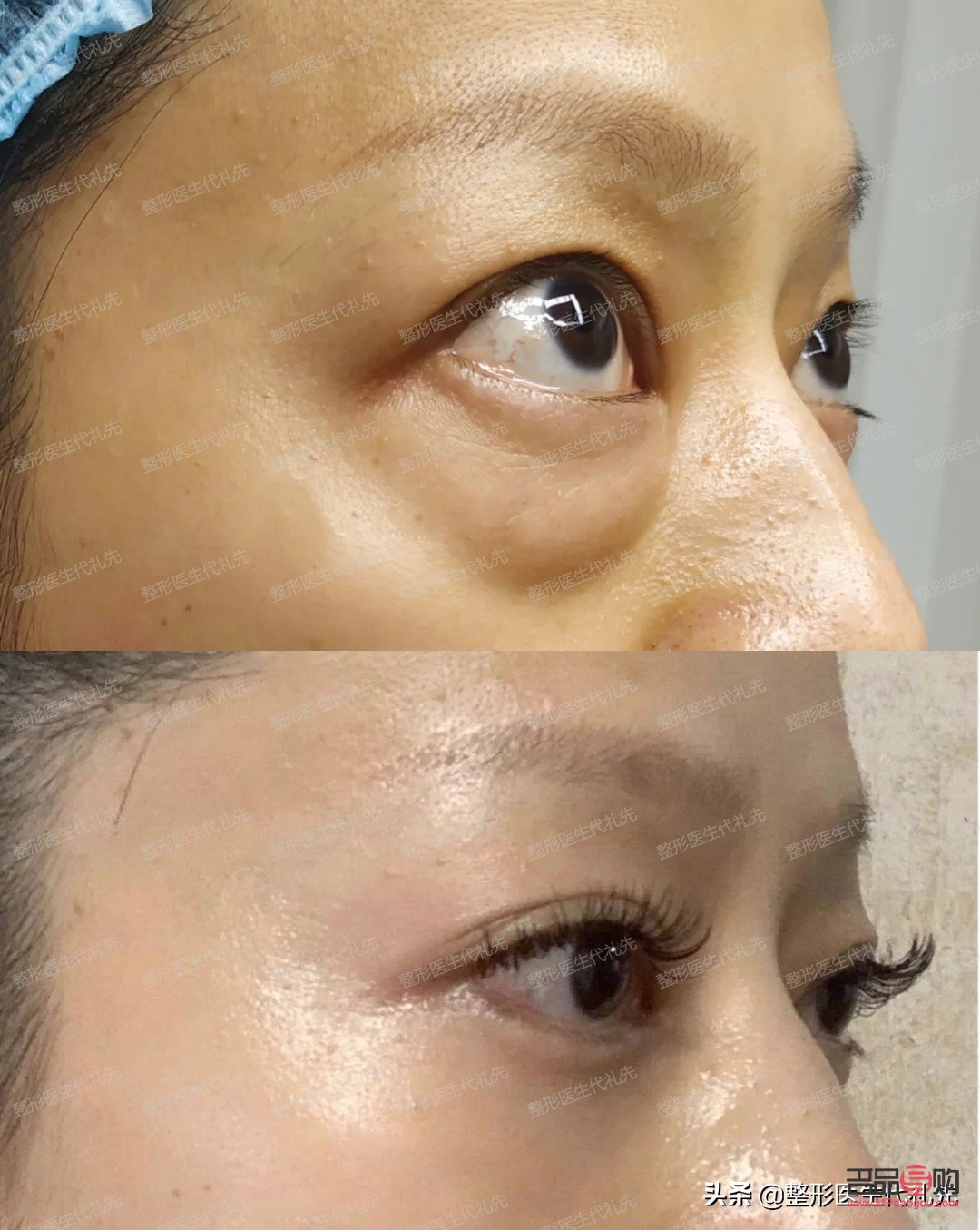 眼袋和淚溝一起做手術可以嗎(眼袋和淚溝一起做手術可以嗎多少錢)