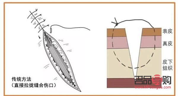 美容縫合留疤嗎(美容縫合留疤嗎會留疤嗎)