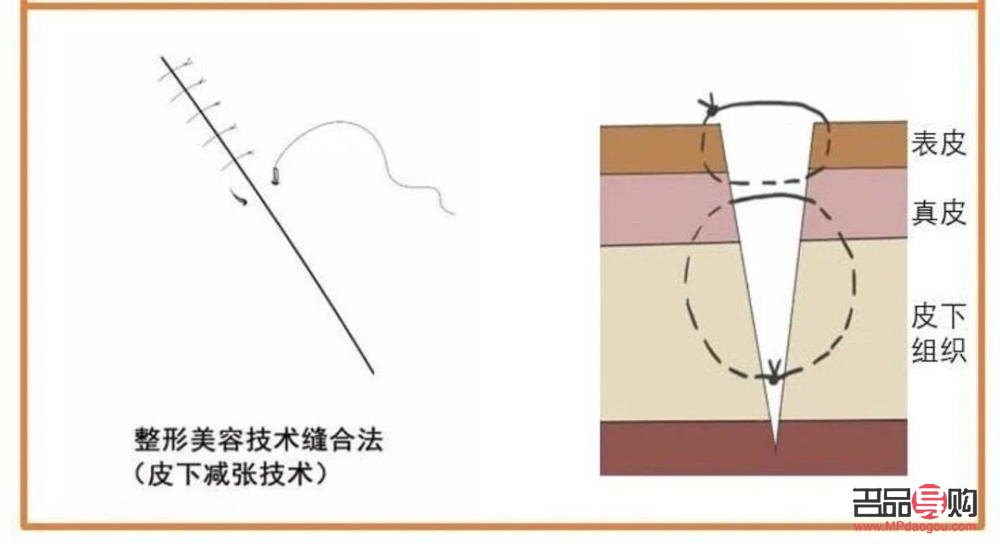 美容縫合留疤嗎(美容縫合留疤嗎會留疤嗎)