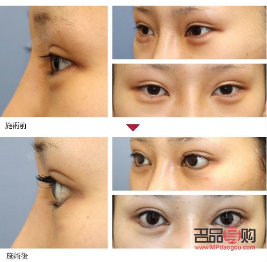 &amp;lt;h1&amp;gt;眼部綜合術(shù)：重塑明亮雙眸的全方位解決方案&amp;lt;/h1&amp;gt;