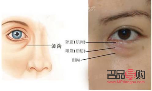<h3>眶隔釋放眼袋整形術的風險性探討</h3>