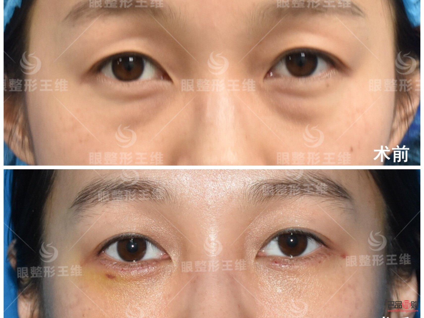 <h3>眶隔釋放眼袋整形術的風險性探討</h3>