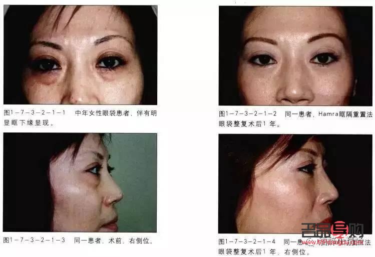 眶隔釋放眼袋整形術(shù)的風(fēng)險(xiǎn)性探討