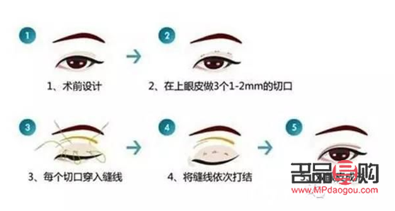 雙眼皮埋線：打造迷人電眼的秘密武器