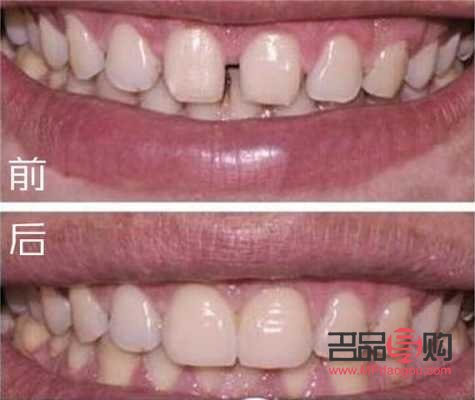 美容冠效果怎么樣(美容冠好不好)
