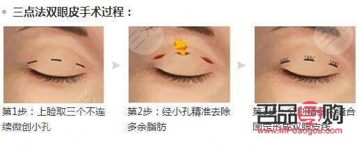 <h3>割雙眼皮手術(shù)對眼睛的可能傷害</h3>