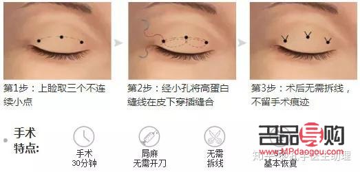 埋線雙眼皮和割雙眼皮哪種好(雙眼皮技術不開刀不埋線)