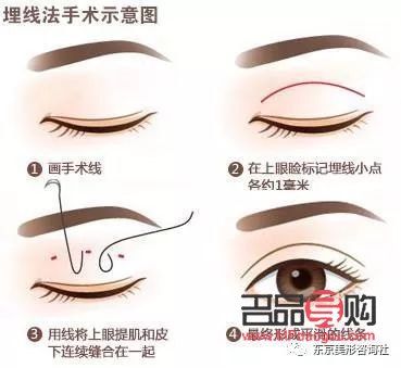 埋線雙眼皮和割雙眼皮哪種好(雙眼皮技術不開刀不埋線)