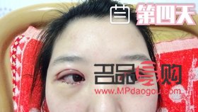 月經期做雙眼皮手術，風險與后果需知