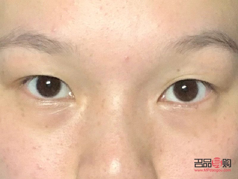 內(nèi)雙腫眼泡的消除秘訣