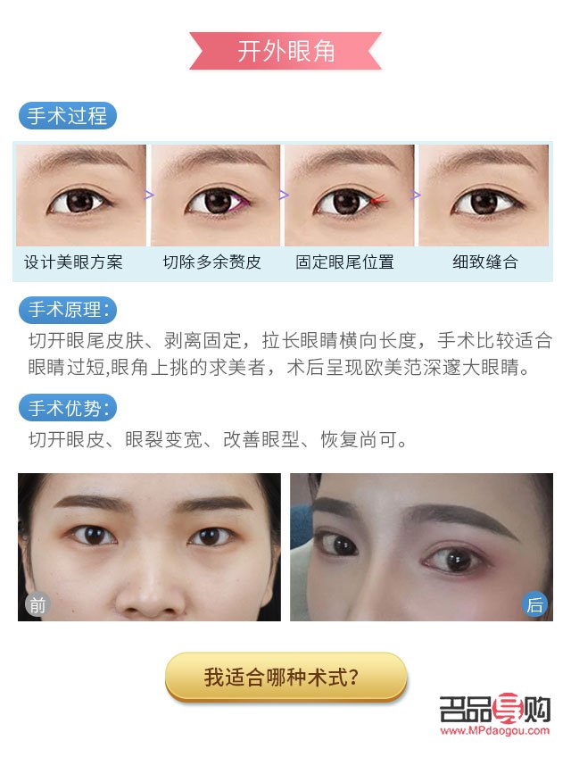 開眼角要多少錢大概(開眼角多少錢?)