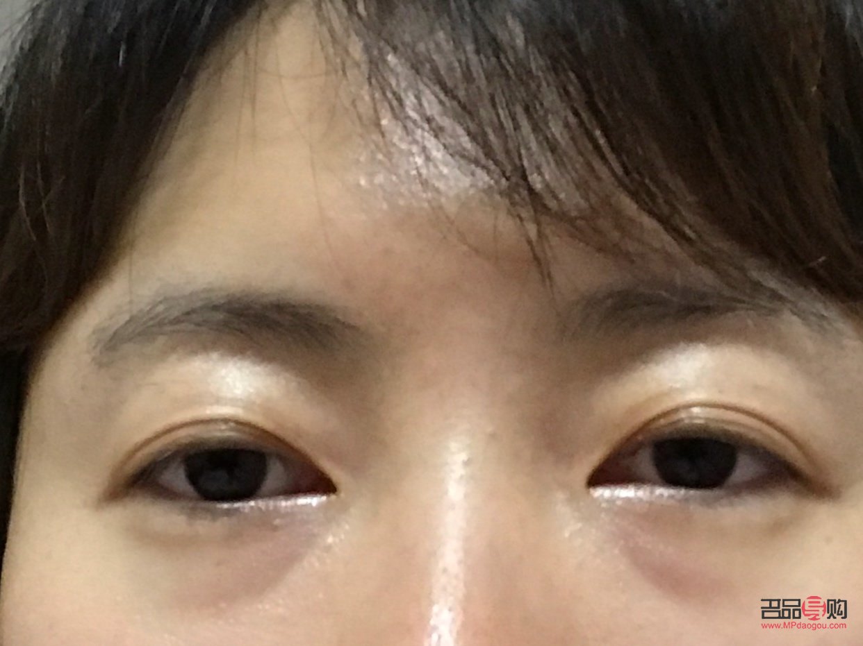 眼袋凹陷怎么恢復(fù)飽滿(眼袋凹陷怎么恢復(fù)飽滿不手術(shù))