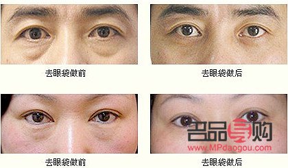 無痕眼袋手術(shù)及其費(fèi)用詳解
