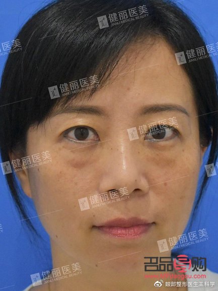 四十多歲，做眼袋手術(shù)是否合適？