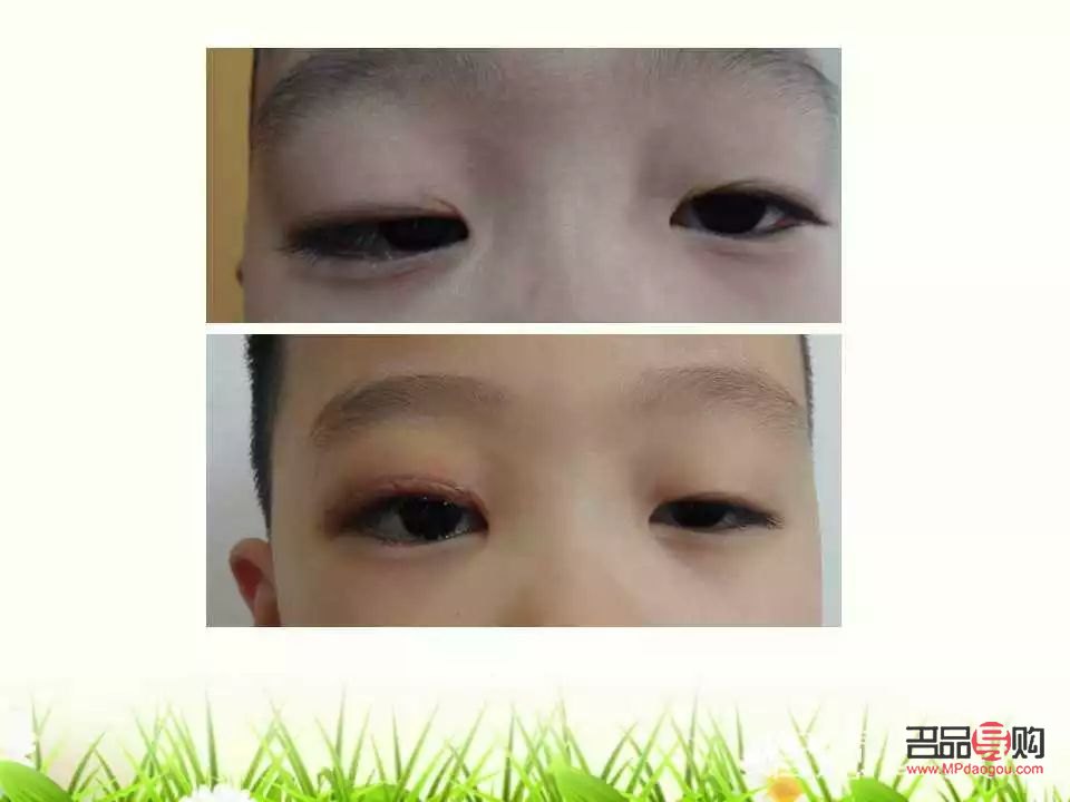 眼角下垂有什么辦法可以調整的(眼角下垂有什么辦法可以調整的小孩)