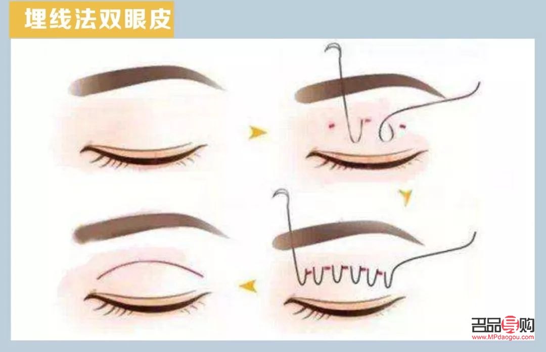 <h3>修復埋線雙眼皮寬度不一的方法與注意事項</h3>