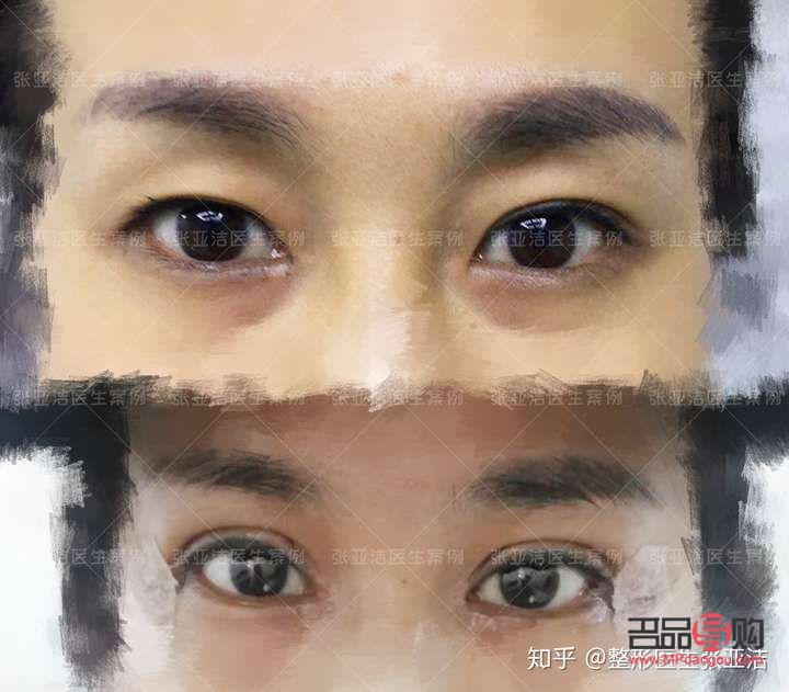 全切雙眼皮和眼綜合區別大嗎(全切雙眼皮和眼綜合區別大嗎多少錢)