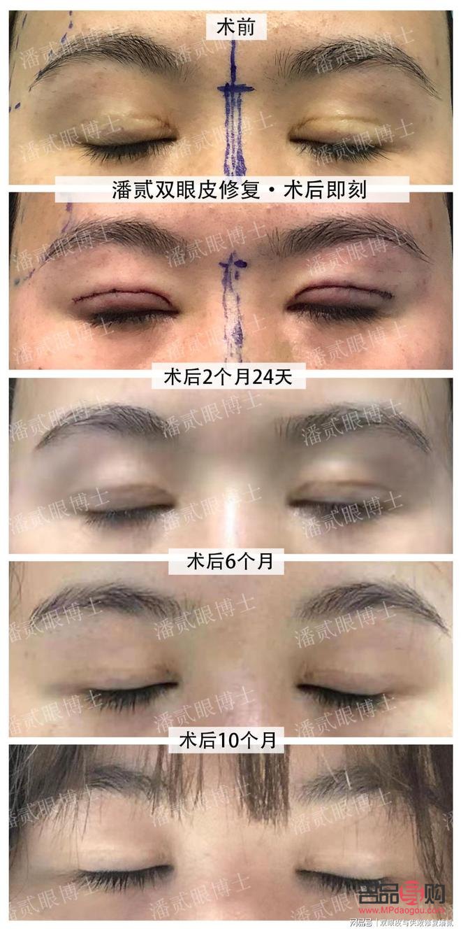 砭石眼部按摩恢復視力(砭石眼部按摩恢復視力有效果嗎)
