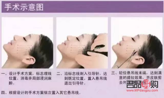 線雕雙眼皮與埋線雙眼皮的區別詳解