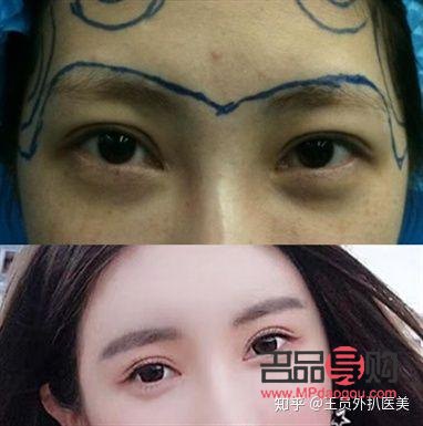 如何應對一個眼皮單一個眼皮雙的困擾？
