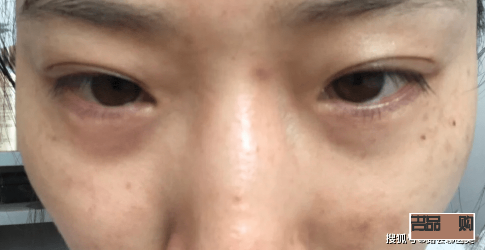眼睛周圍凹陷怎么恢復飽滿的方法(眼睛周圍凹陷怎么恢復飽滿的方法圖片)