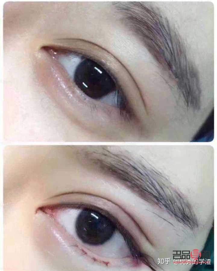 現在流行什么雙眼皮手術(現在流行什么雙眼皮手術效果好)