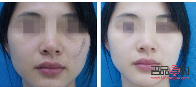 美容針能否完全去除疤痕？
