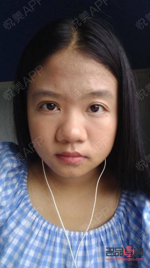 <h3>大小眼手術可能帶來的后遺癥</h3>