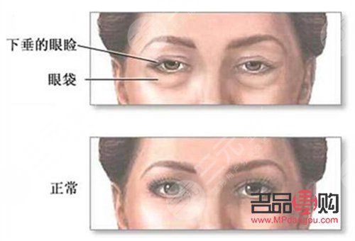 割眼袋有風險嗎(割眼袋有風險嗎?)