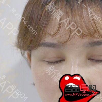 <h3>雙眼皮手術如何自然不顯假</h3>