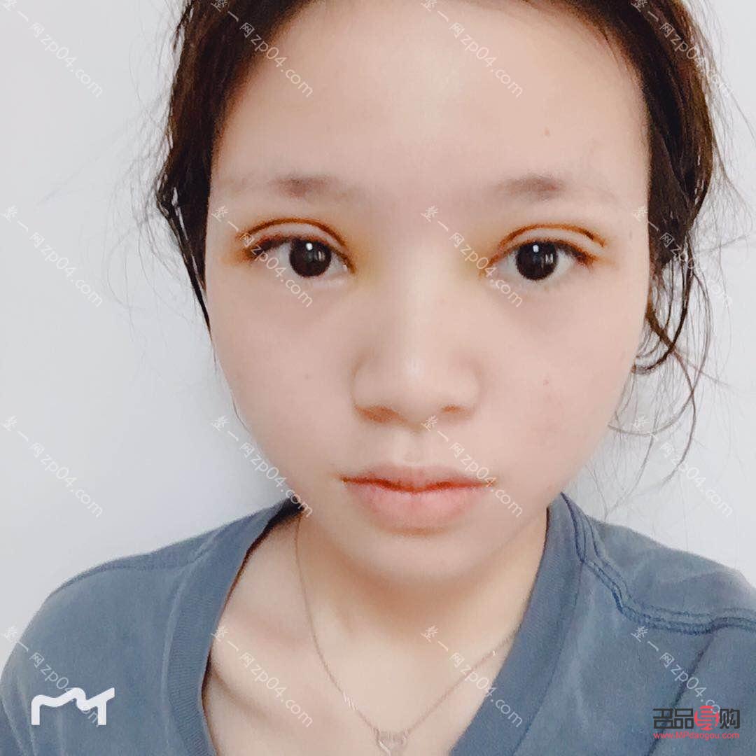 雙眼皮手術如何自然不顯假