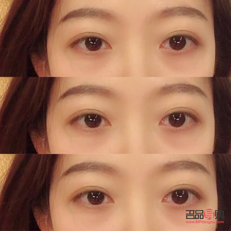 雙眼皮手術有幾種款式圖片(雙眼皮手術有幾種款式圖片及價格)